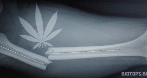 Le cannabis accélère les guérisons des fractures osseuses