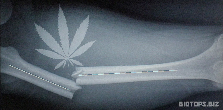 Le cannabis accélère les guérisons des fractures osseuses